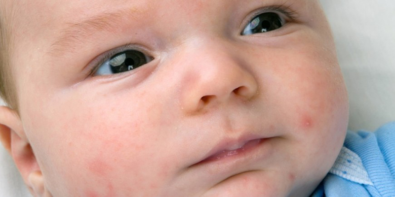 Comment traiter la peau rouge de bébé ?