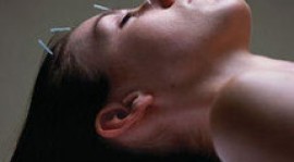 Les bienfaits de l&rsquo;acupuncture pendant la grossesse