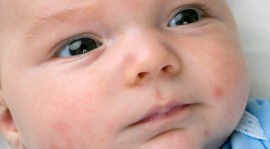 Comment traiter la peau rouge de bébé ?
