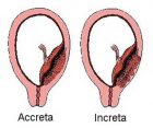 Placenta accreta ou la mauvaise implantation du placenta