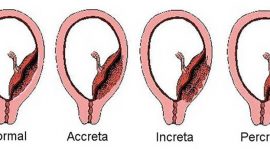 Placenta accreta ou la mauvaise implantation du placenta