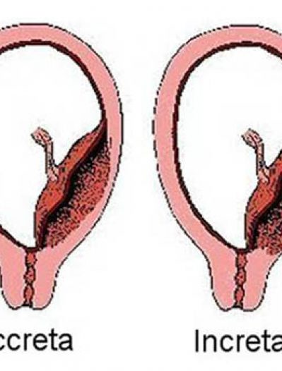 Placenta accreta ou la mauvaise implantation du placenta