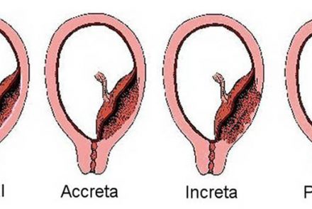 Placenta accreta ou la mauvaise implantation du placenta