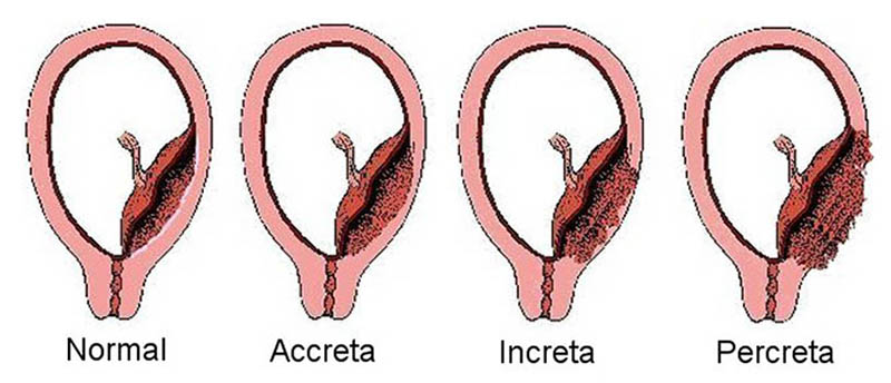 Placenta accreta ou la mauvaise implantation du placenta